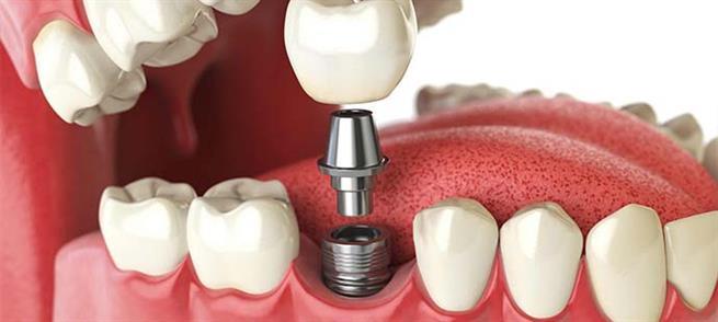 Что такое зубной имплантат?