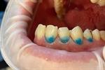 Лечение зубов в Анталье